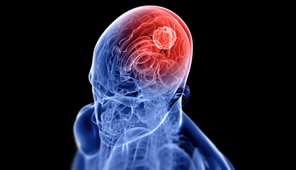 顱內立體定位放射手術(Intracranial Stereotactic Radiosurgery, SRS)