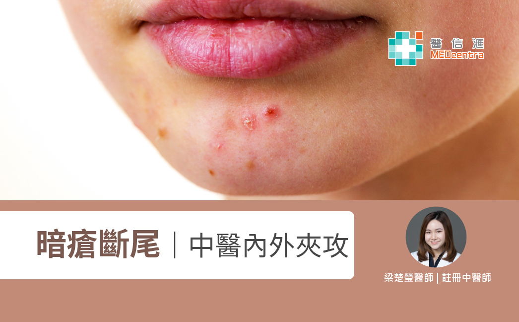 中醫暗瘡 梁楚瑩醫師