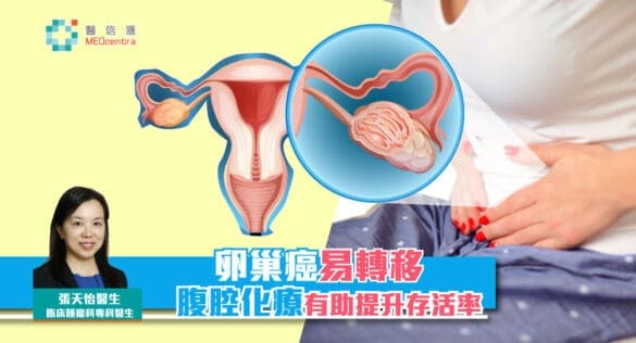 卵巢癌腹腔化療