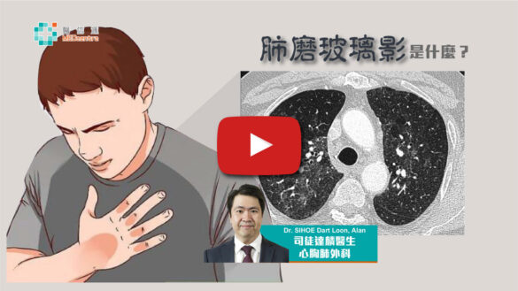 肺磨玻璃影