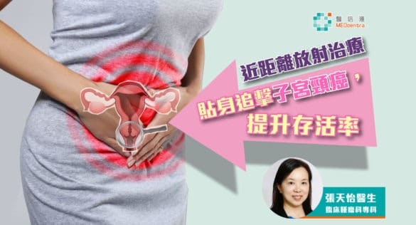 近距離放射治療(Brachytherapy)貼身追擊子宮頸癌-–-提升存活率